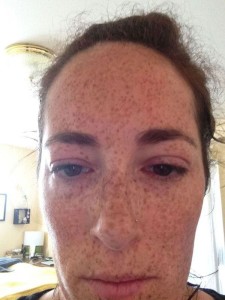Katy VanNostrand durante una reacción alérgica 